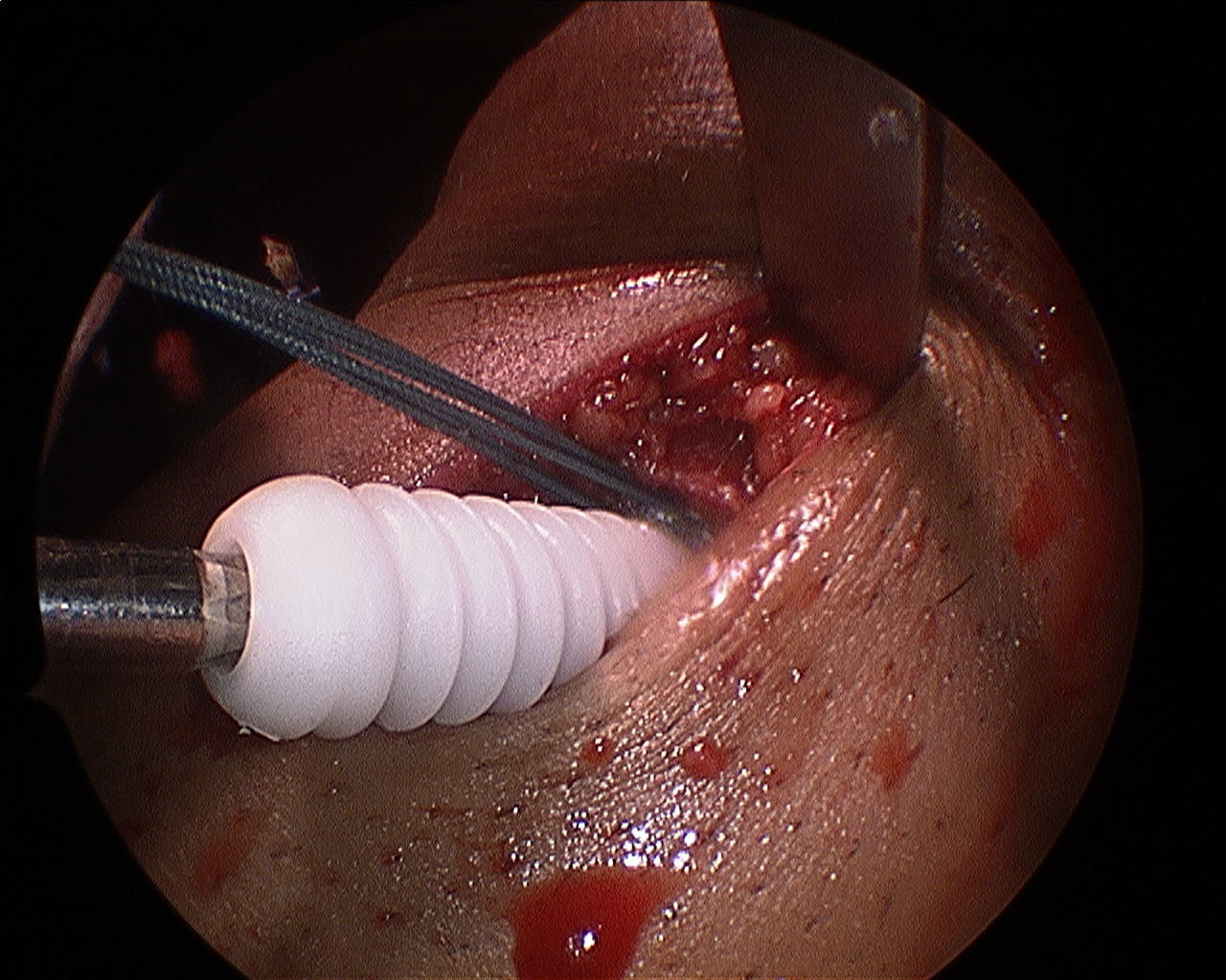 ACL GRAFT FIXATION WITH BIO SCREW
