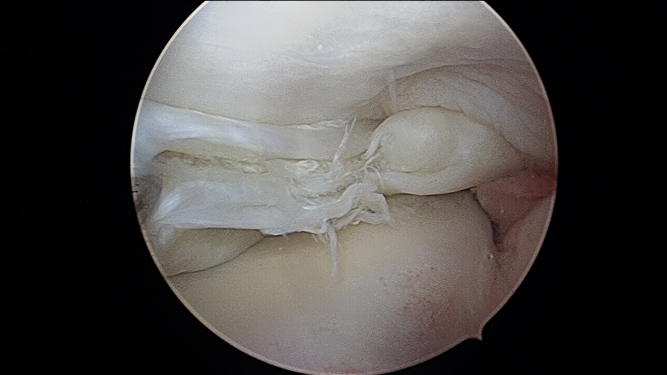 BUCKET HANDLE TEAR OF MEDIAL MENISCUS 1