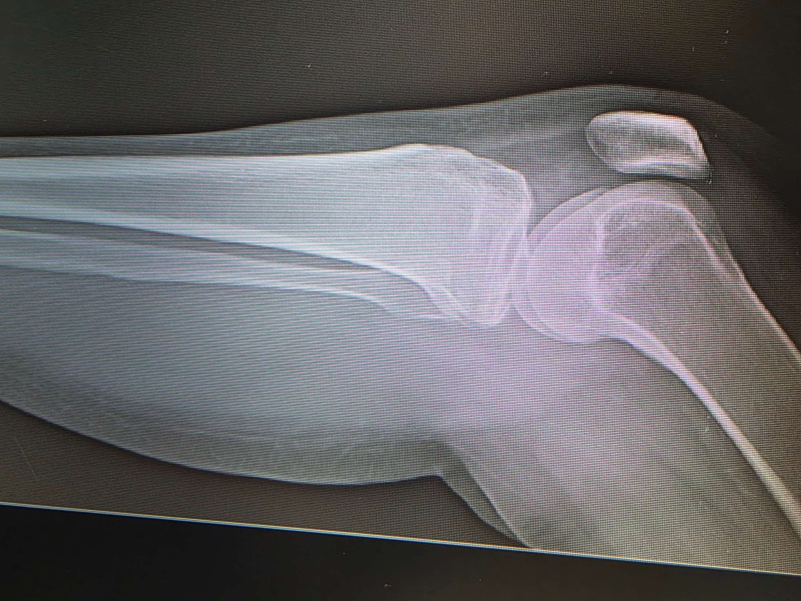 KNEE PCL TEAR LATERAL 1 scaled e1780046282613