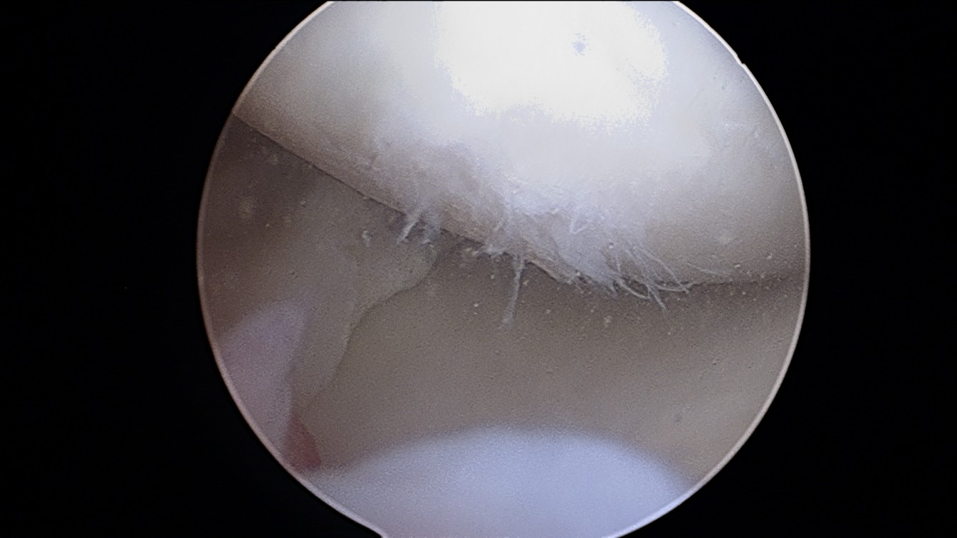 MEDIAL MENISCUS BALANCING DONE 1