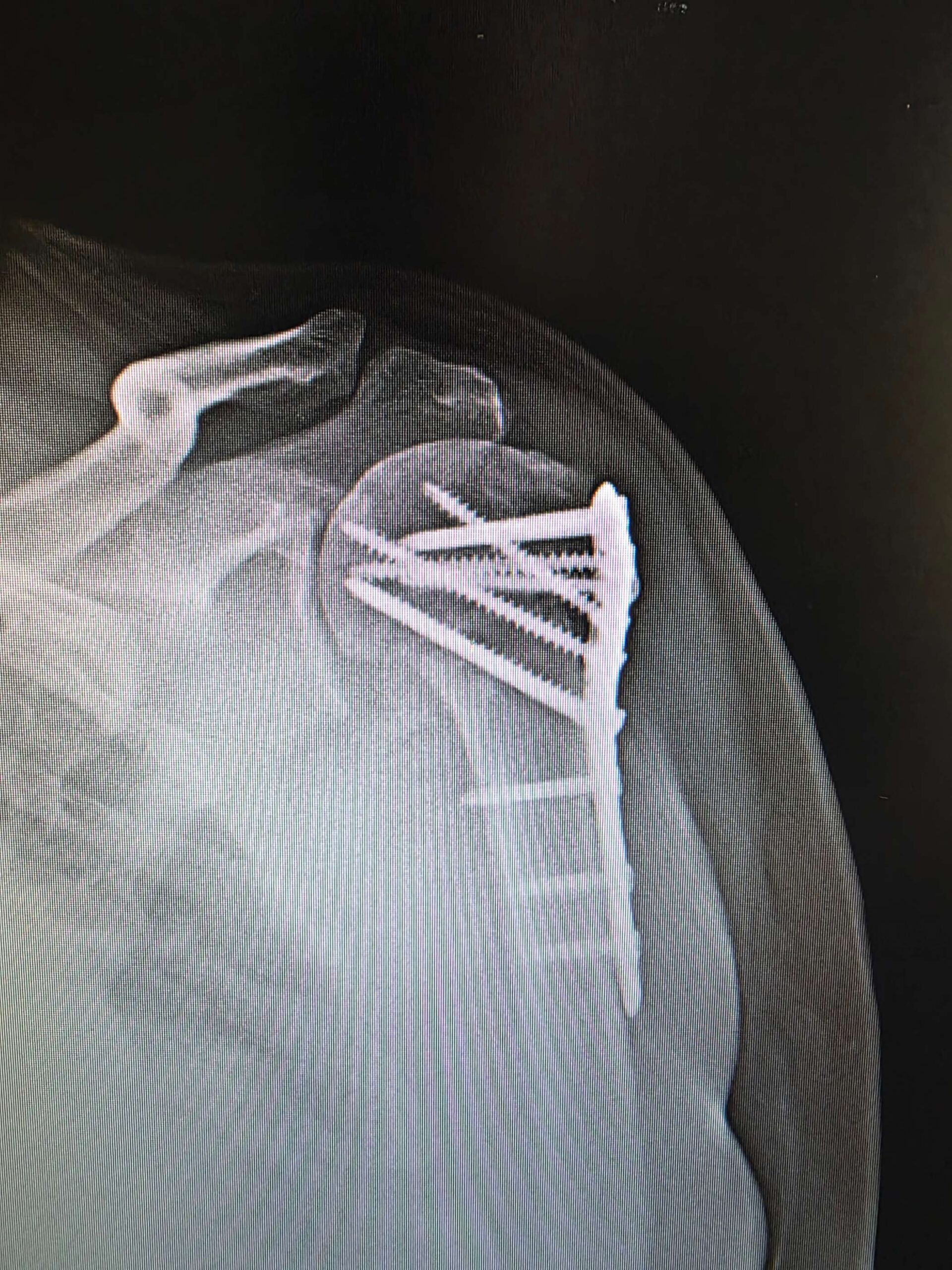 POST SHOULDER FIXATION WITH NON FUNCTIONAL CUFF scaled