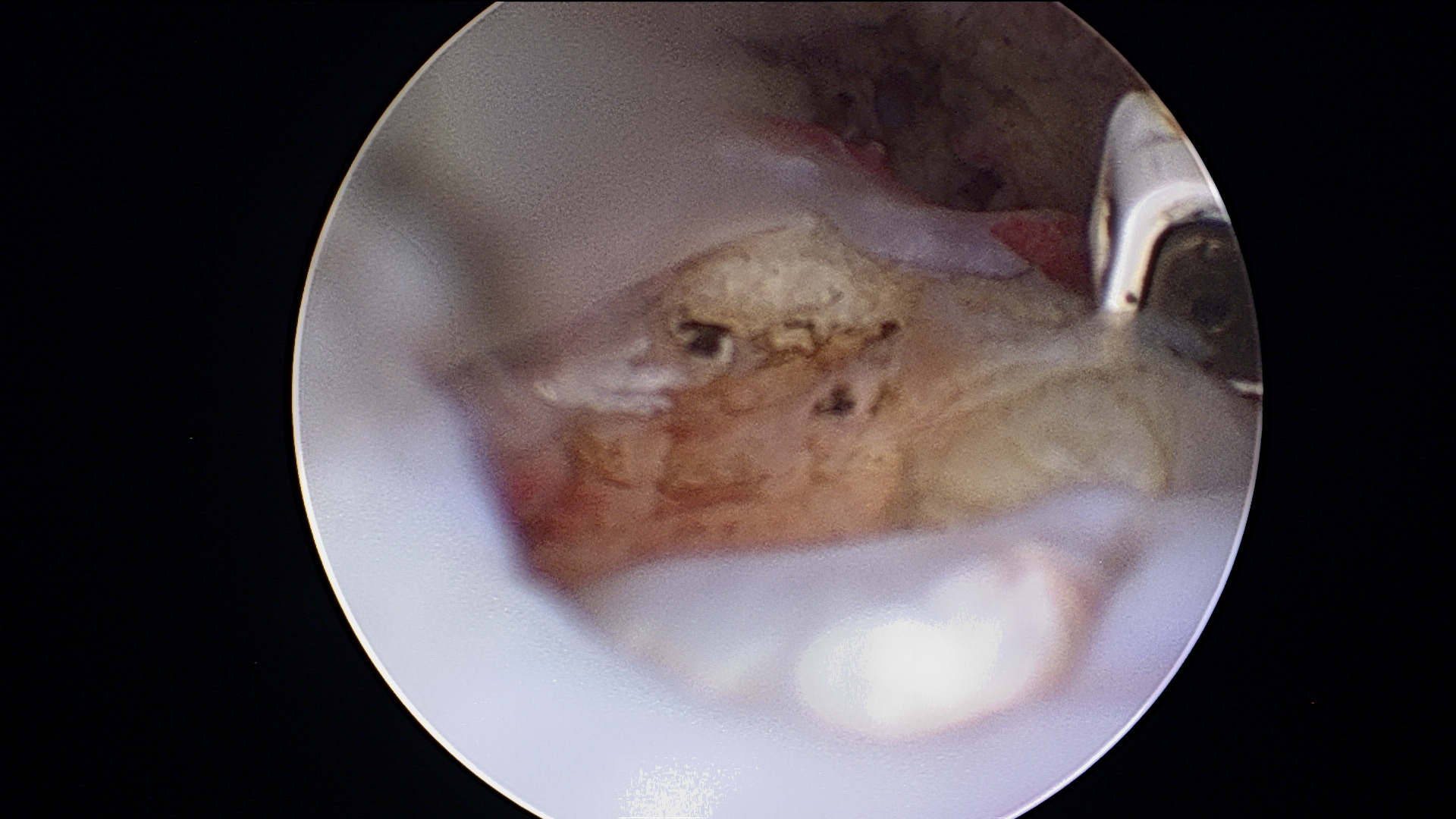 ROTATER CUFF TEAR